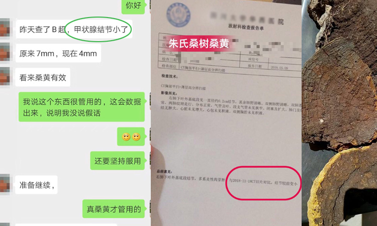 甲狀腺結(jié)節(jié)吃桑樹桑黃案例 甲狀腺結(jié)節(jié)吃桑樹桑黃案例